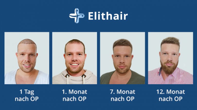 Haartransplantation Vorher-Nachher: Top-Resultate