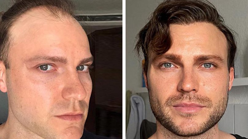 Haartransplantation Erfahrung Elithair